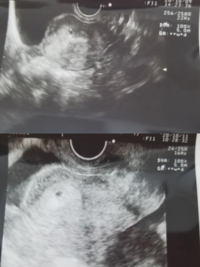 胎嚢の大きさについてです 上の写真が4週4日で 下の写真が4週6日です Yahoo 知恵袋