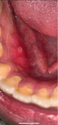口内炎 歯茎 歯根破折（しこんはせつ）とは…膿などの症状・治療法 [歯・口の病気]