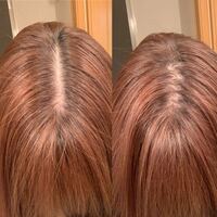 代ですが分け目ハゲに悩んでいます 全体的に毛量は多い Yahoo 知恵袋