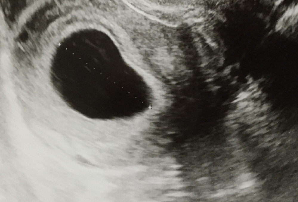 妊娠6週目で胎嚢13mm妊娠8週目にして胎嚢35mmどちらも胎嚢のみ確認 Yahoo 知恵袋