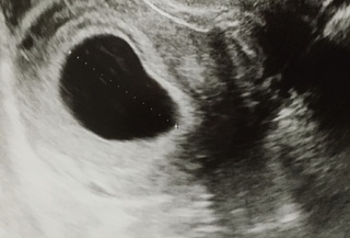 のみ 胎嚢 6 週