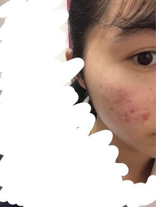 学校でずっとマスクをしておかなければならないので右頬だけニキビ Yahoo 知恵袋