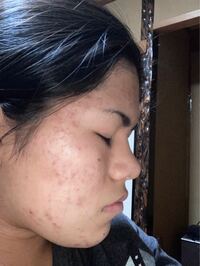 太っているのですが痩せたら横の鼻綺麗になるでしょうか 158c Yahoo 知恵袋