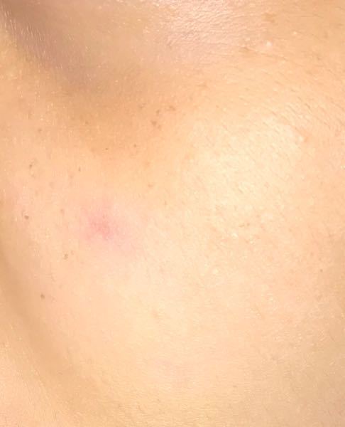 至急です 一か月くらいまえから頬に小さくて赤いシミ