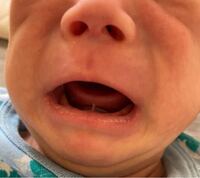 舌小帯短縮症について 現在生後１ヶ月の乳児が居ます 生まれ Yahoo 知恵袋