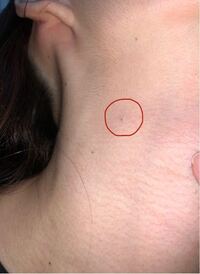 閲覧注意 首に小さな出来物ができ つまむとしこりみたいにコリコリ Yahoo 知恵袋