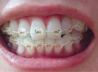 このワイヤー矯正はなんの種類かわかる方いますかー クリッ Yahoo 知恵袋