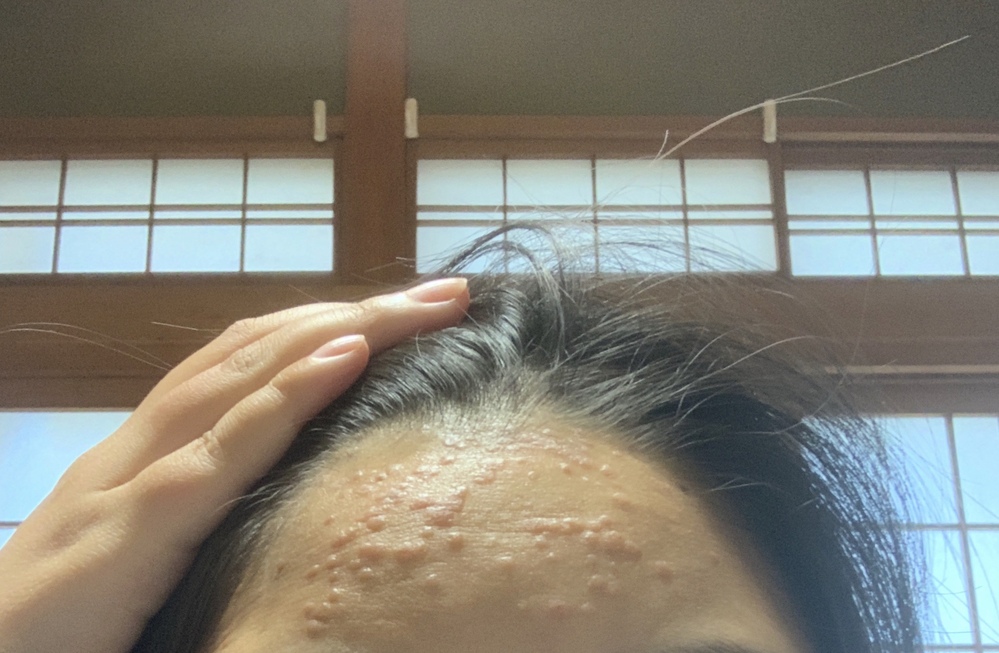 一週間程前から額や首の生え際に赤いぶつぶつが出て痒みがあるのですがなんで Yahoo 知恵袋