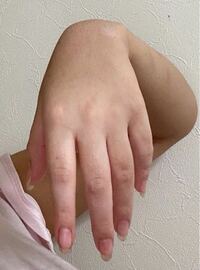 手の指の辺りは白いのにその他が黒いです 生まれつきアトピーなので色素沈着 Yahoo 知恵袋