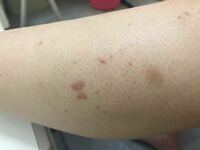 身体 足 腕 にこのようなポコッとした赤い斑点があります Yahoo 知恵袋