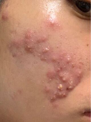 このニキビは跡になりますか 2週間くらい前に大量にできて 笑った時などに Yahoo 知恵袋