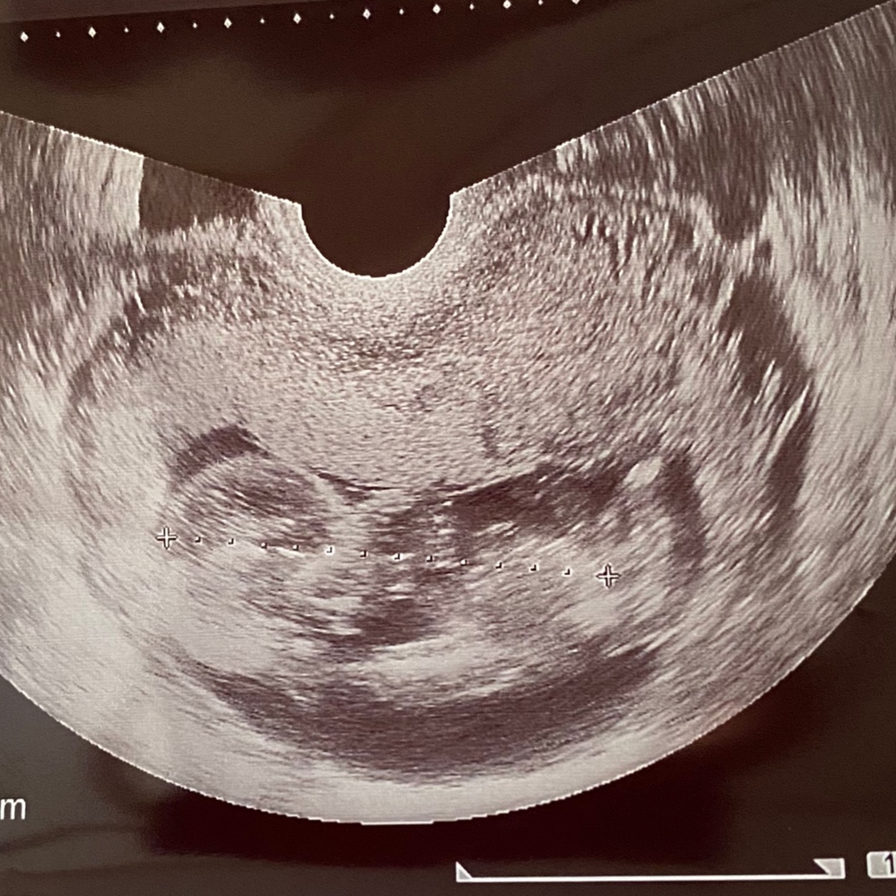 妊娠4カ月のエコー写真です 性別が分かる方いらっしゃいますか Yahoo 知恵袋