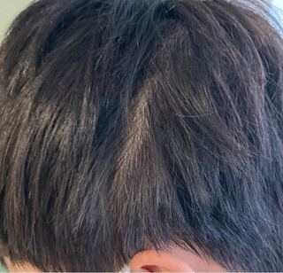 これはハゲですか 中学生です Yahoo 知恵袋