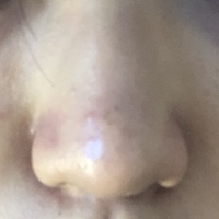 こんにちは 高校一年生女子です 鼻の毛穴詰まりに悩んでいます Yahoo 知恵袋