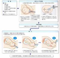 吸引分娩で吸引カップを装着するとき 大泉門を避けるのは何故です Yahoo 知恵袋