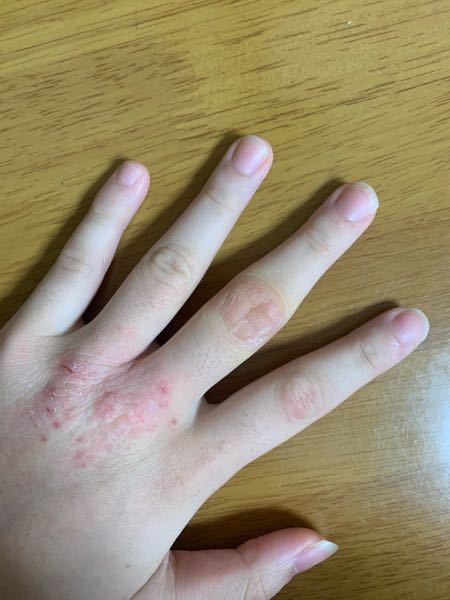 左手の中指と人差し指の第二関節が腫れているのですが - これは 