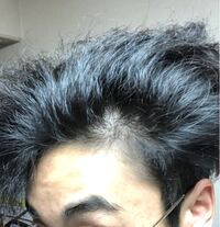 最近髪スカスカ具合がやばいです 生え際の位置は変わらないのですが Yahoo 知恵袋