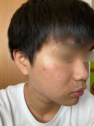 高校3年洗顔もしてるのにこのように肌が汚いです肌断食というのは効果でます Yahoo 知恵袋