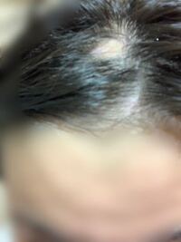 美容師さんについてなんですけど私は円形脱毛症になってしまって美容室に行 Yahoo 知恵袋