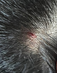 頭痒いです 頭皮湿疹でしょうか Yahoo 知恵袋