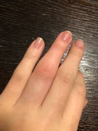 体育のバスケ中 突き指をしたんですけど 曲げると痛い状態です Yahoo 知恵袋