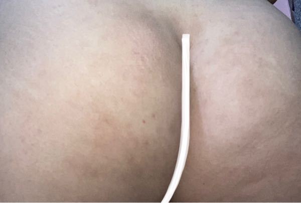 小学生のころアトピーになってしまってその時掻きむしったせいで色素沈着して Yahoo 知恵袋