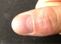 爪の周りの肌荒れがひどいです 症状が出ている指は右手の親指と人 Yahoo 知恵袋