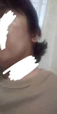 大人の吹き出物についてここ何ヶ月ストレスのせいなのか食生活のせいなのか Yahoo 知恵袋