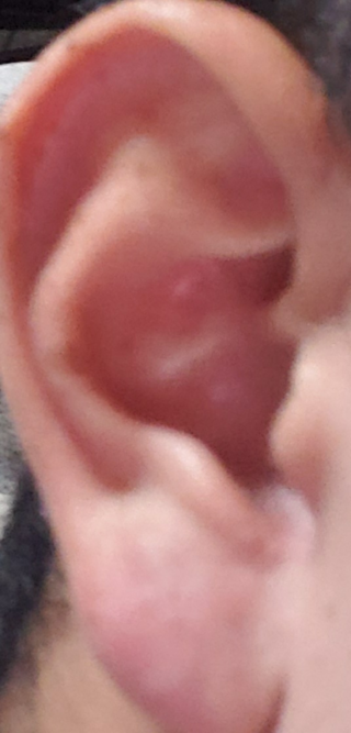 耳たぶにしこりのようなものがあるんですがこれはなんでしょうか Yahoo 知恵袋