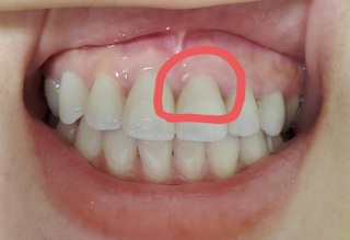 汚くてすみませを この歯茎は歯槽膿漏 歯肉炎 歯周病でしょうか Yahoo 知恵袋