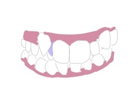 歯の隙間にぷにぷにしたものがあるなあと思って鏡を見たら 歯茎が Yahoo 知恵袋