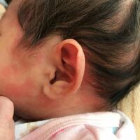 新生児 中毒 疹 胎脂とは？新生児の肌がカサカサになる原因は？対処は必要？