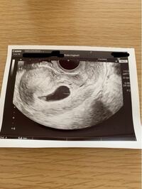 当方30代の妊婦です エコー写真について質問します 6w Yahoo 知恵袋