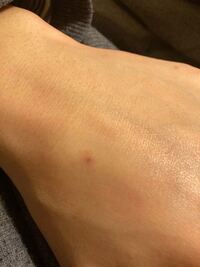 2 3週間ほど前から手の甲の皮膚の内側に黒い点ができました 急にホクロが Yahoo 知恵袋