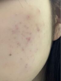 成人式のメイク 助けてください 私はニキビとニキビ跡 色素沈着 が額 Yahoo 知恵袋