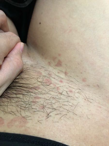 閲覧注意股の脇に赤い斑点のようなものができてしまいました 何かわかる方い Yahoo 知恵袋