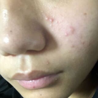 閲覧注意中学2年生の肌です 赤みなどニキビが全然治りません スキンケアな Yahoo 知恵袋