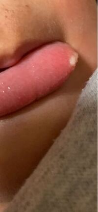 2歳の子供の舌に写真のような白い出来物ができてて 昨日からあり Yahoo 知恵袋