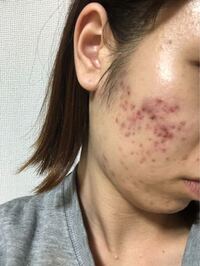 クロロフィルをやって2ヶ月です ここの頬に二 三個しかニキビなかっ Yahoo 知恵袋