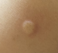 急に二の腕にまんまるのぷっくりしたできものができていました 本 Yahoo 知恵袋