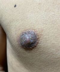 19歳男です 1月ほど前から右乳首が痒くなり 現在写真のような状態 Yahoo 知恵袋
