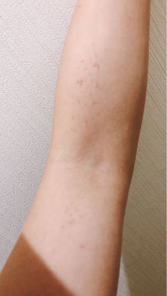 3日前に両腕に赤い斑点のような痣が出来ていることに気づきました い Yahoo 知恵袋