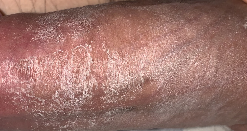 画像のように陰茎の皮が乾燥したように薄皮が剥がれます このくら Yahoo 知恵袋