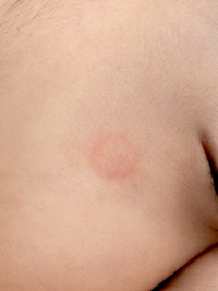 3日前に11ヶ月になる子どもの顔に 赤い丸い湿疹が出ています 特に Yahoo 知恵袋