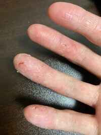 指がボロボロです 大学生なので手を使う仕事をしているわけではな Yahoo 知恵袋