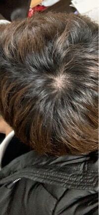 最近つむじが痛く髪の毛が柔らかくなった気がします ハゲですか Yahoo 知恵袋