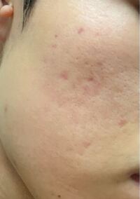 このニキビは今どういう状態 赤ニキビのなのか色素沈着なのかクレ Yahoo 知恵袋