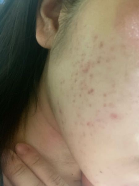 ニキビケア 解決済みの質問 Yahoo 知恵袋