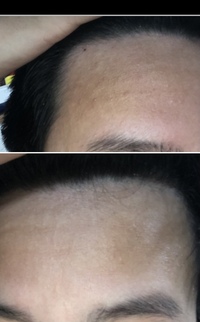 高3でm字ハゲで悩んでいます 現在 どのくらいagaが進行しているのでし Yahoo 知恵袋