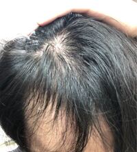 代前半です 片方の頭頂部から前髪にかけて相当薄毛なのですが これはa Yahoo 知恵袋